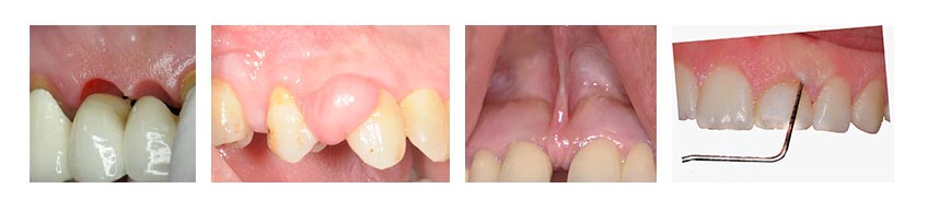 Temel Periodontal Cerrahi ve Estetik Dişeti Seviyeleme Eğitimi